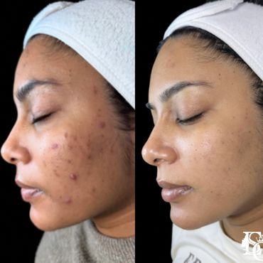 Before and after of a woman from India with inflamed cystic and acne scars.