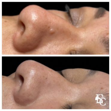 Fibrous papules on the nose