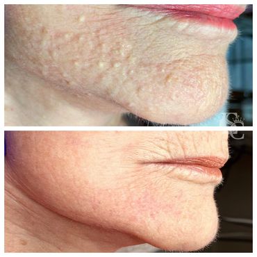 A woman on her 70's with lots of milia, age spots and sebaceous hyperplasia on her face.
