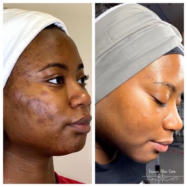 Face Reality Acne Bootcamp for those suffering from mild to severe acne for teens and adults.