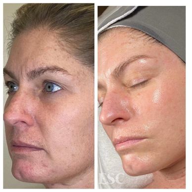 DMK Muscle Banding result for sagging face & neck, skin brightening, cross-linking & glycation.
