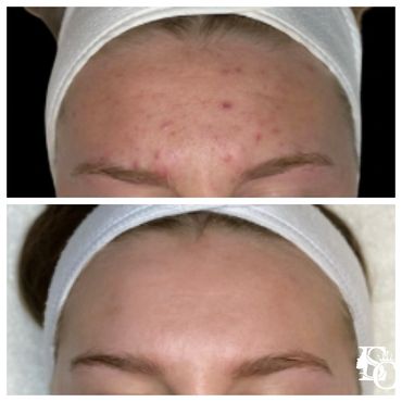 Before and after results of forehead acne treatment showing clear, smooth skin.