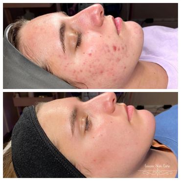 Acne Bootcamp this is a commitment program for those suffering from acne. Young and adults.