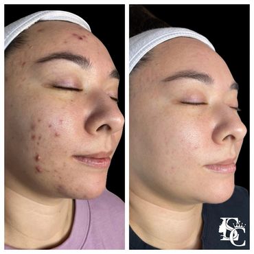 Before & after photo showing reduction in acne and smoother skin texture after acne treatment