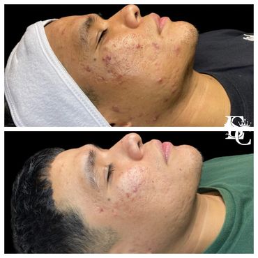 Mexican male before & after, adult & hormonal acne & acne scars cleared with Face Reality.