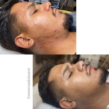 A Mexican guy with inflamed, cystic and hormonal acne on face and neck.