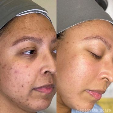 Acne treatment and nano infusion rejuvenating facial for hyperpigmentation done acne specialist. 