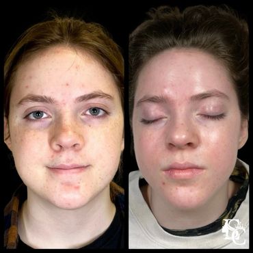 Before and after cystic acne treatment with visible reduction in breakouts and redness.