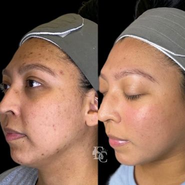 Woman with adult and hormonal acne
