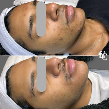 Indian teen before & after clear skin, acne scars gone with Face Reality Acne Boot Camp at Eneeva