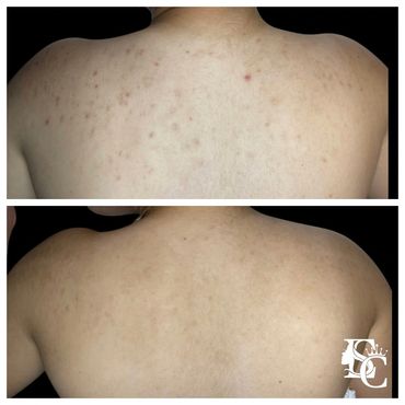 back acne