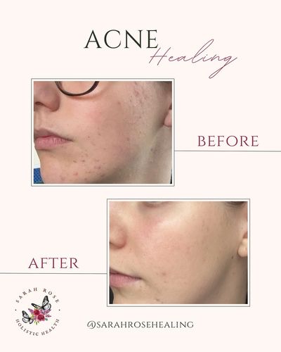 acne healing with natural remedies