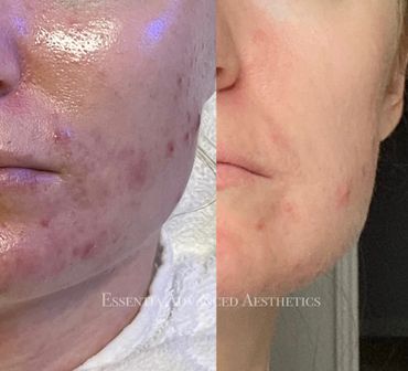 Cystic acne