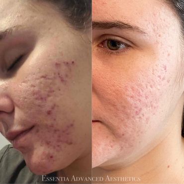 Acne and scarring