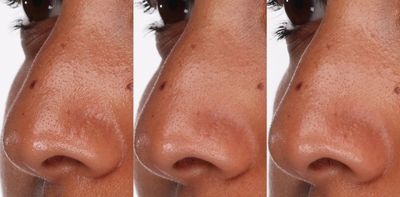 A Before & After close up picture of blocked and enlarged pores on a female clients nose
