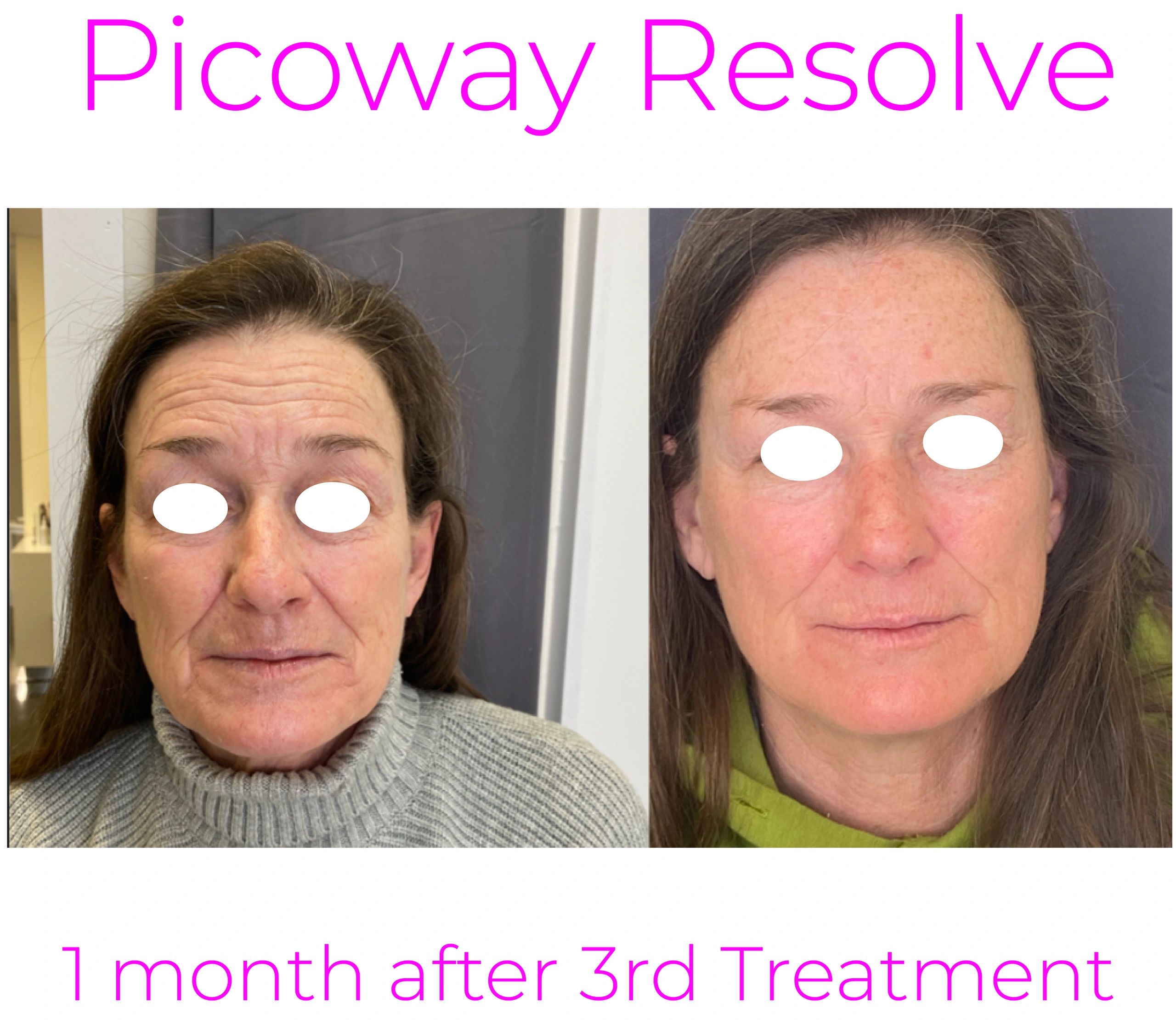 This 58 year old  client had monthly Picoway Resolve treatments, this is 1 month after her 3rd treat