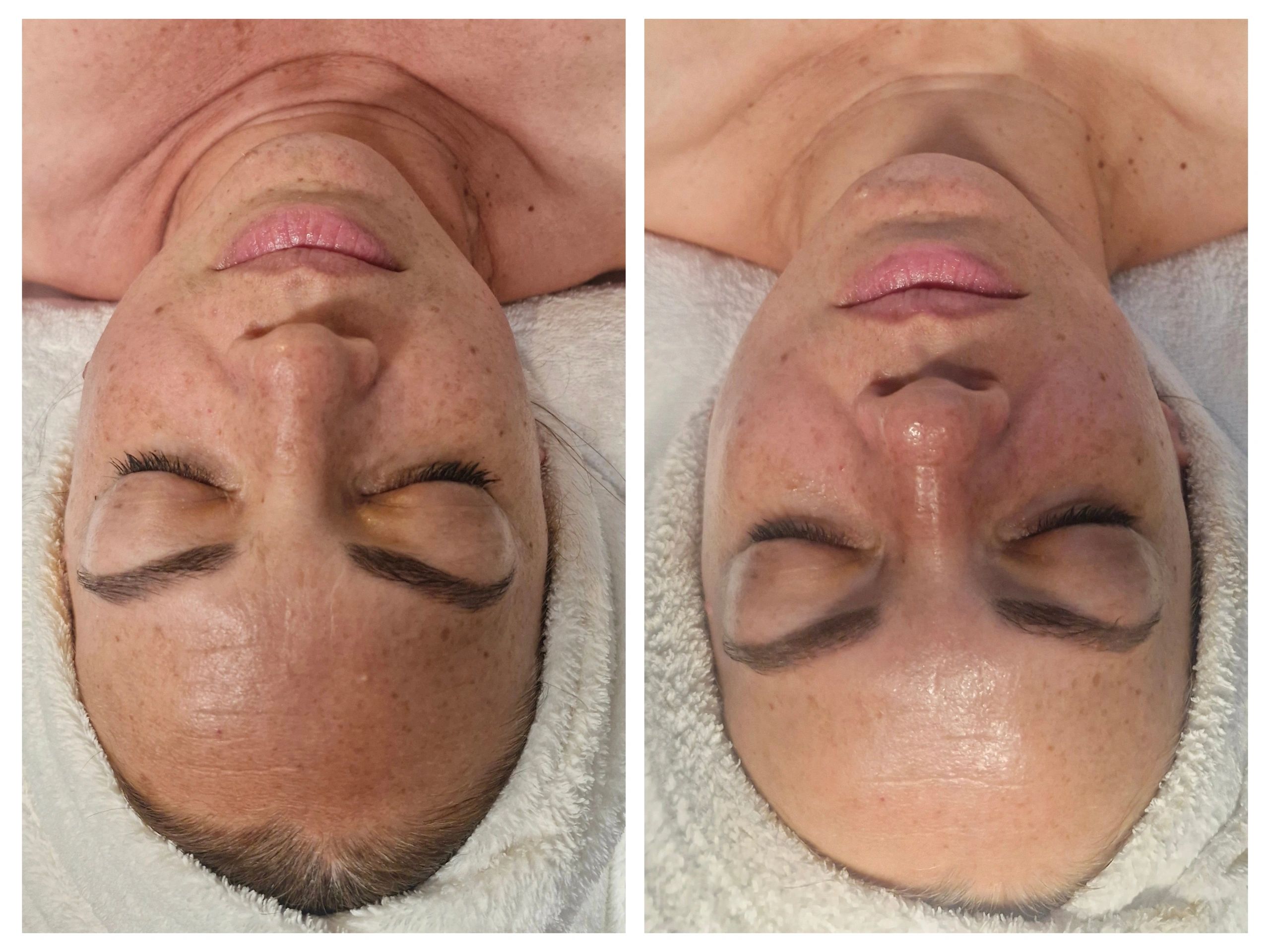 Before and After of Jet Plasma skin treatment near Paradise Point, Runaway Bay and Hope Island