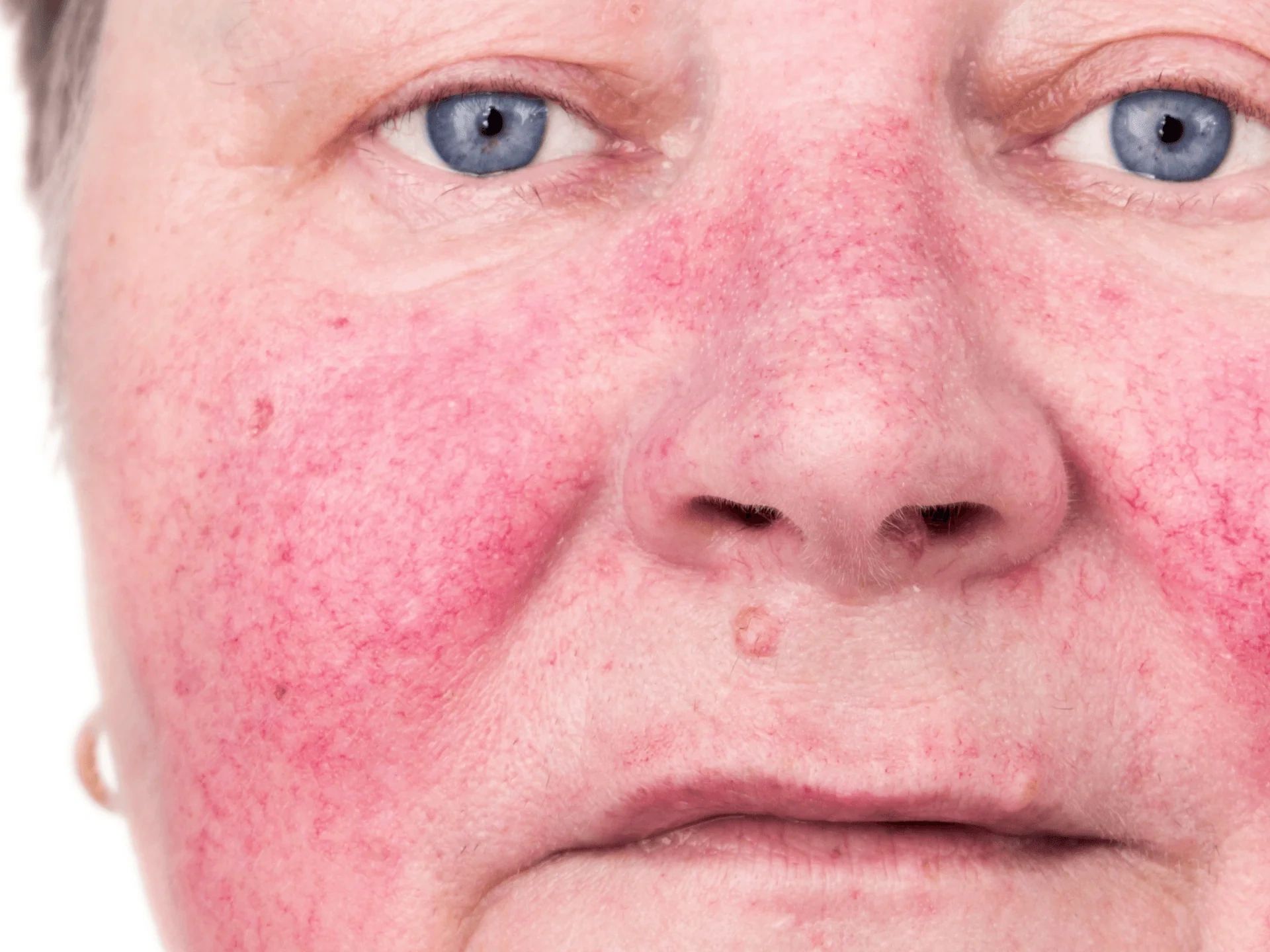 Close-up of a face with rosacea showing red, inflamed skin.