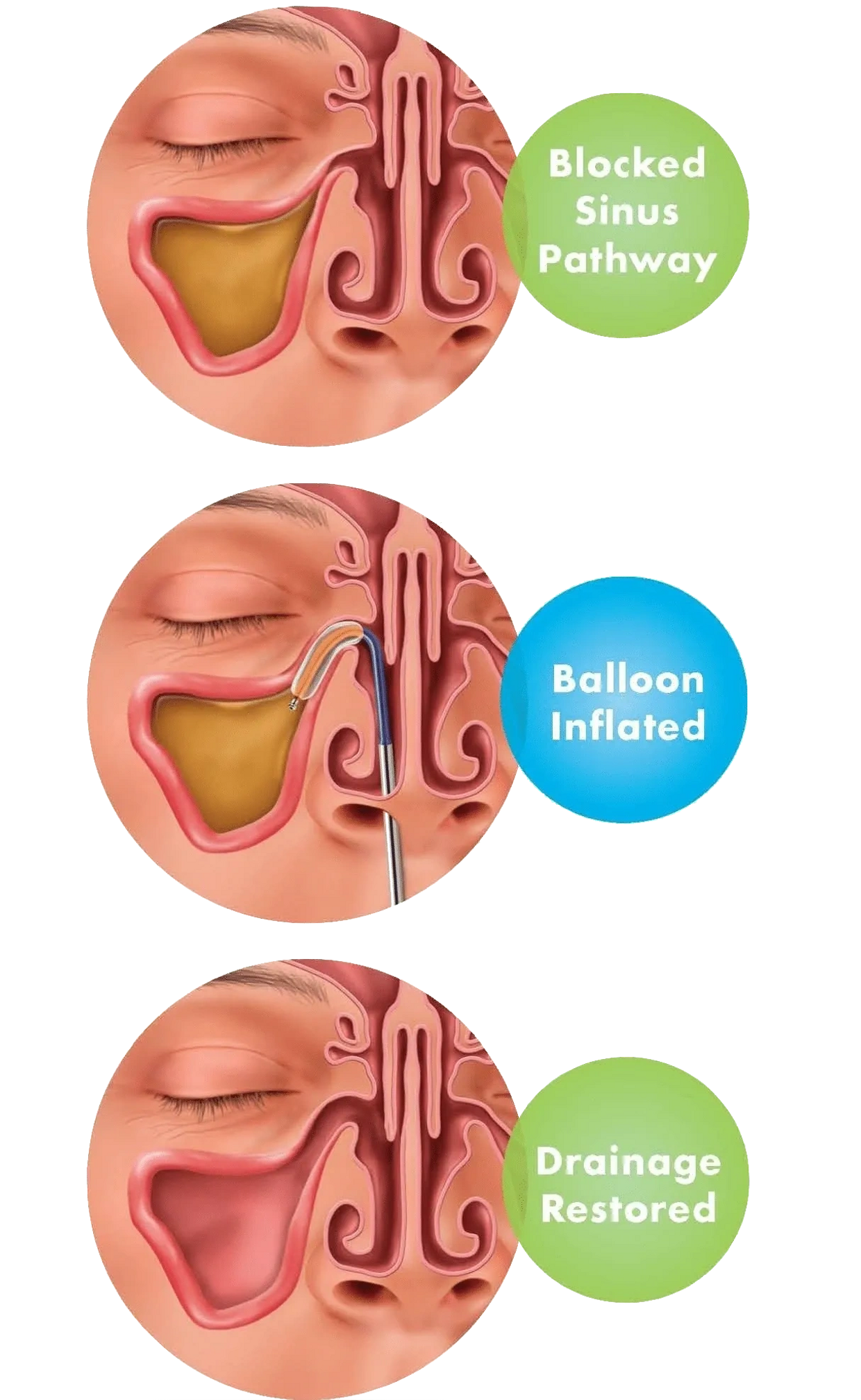 Balloon dilating the maxillary sinus