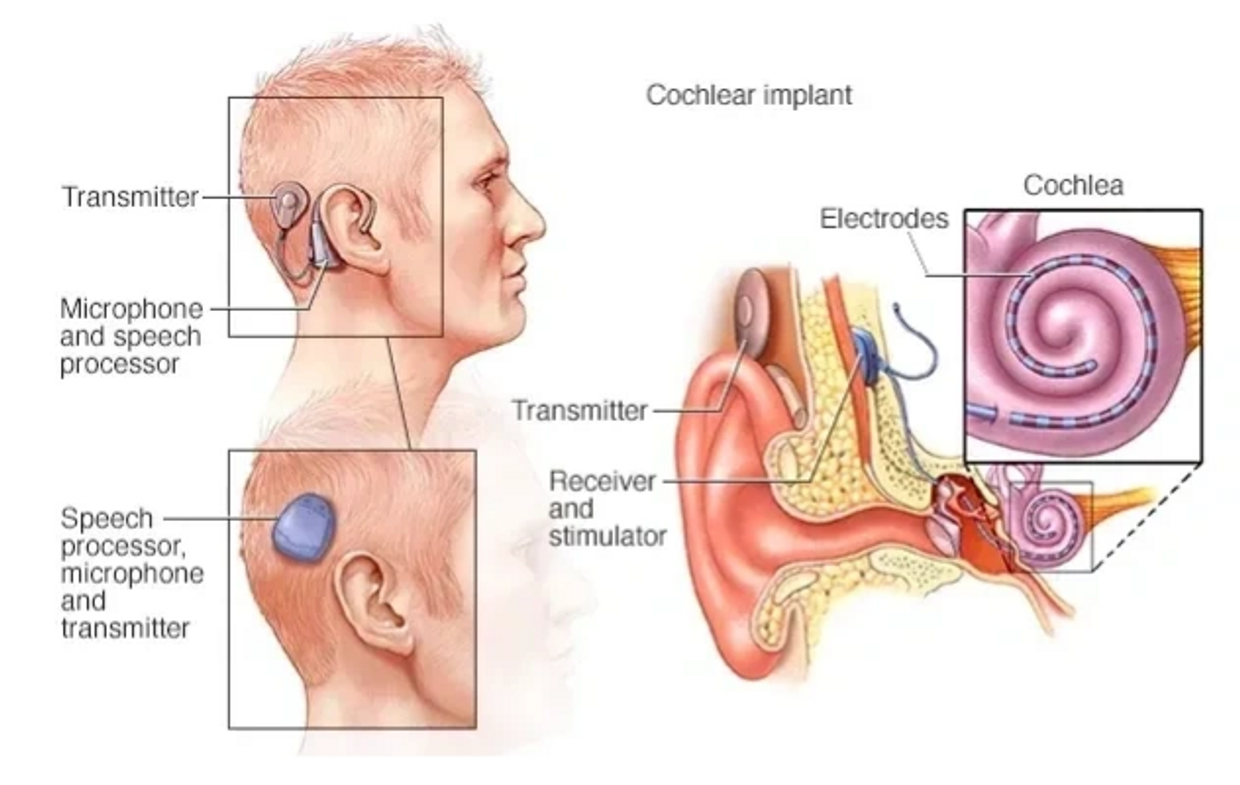 Cochlear Implant