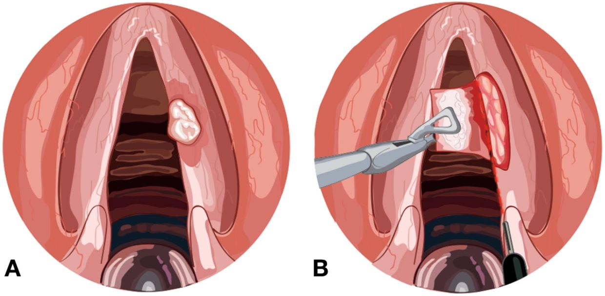 Laryngeal growth removed by CO2 Laser