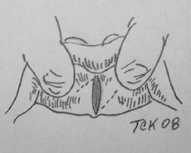 Frenectomy ,Frenum, Suture