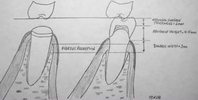 Crown lengthening, Biological Width,Fractured Tooth,Crown, Root Canal