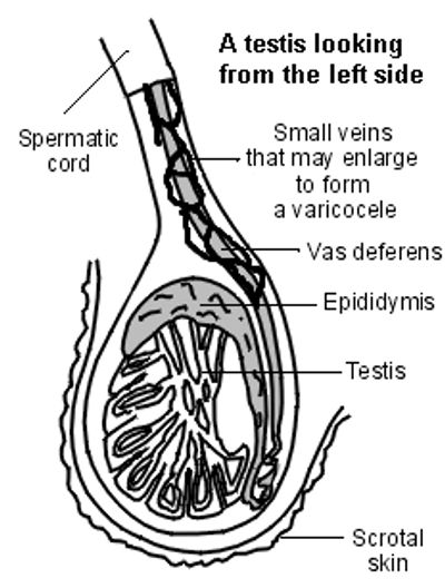 Varicocele