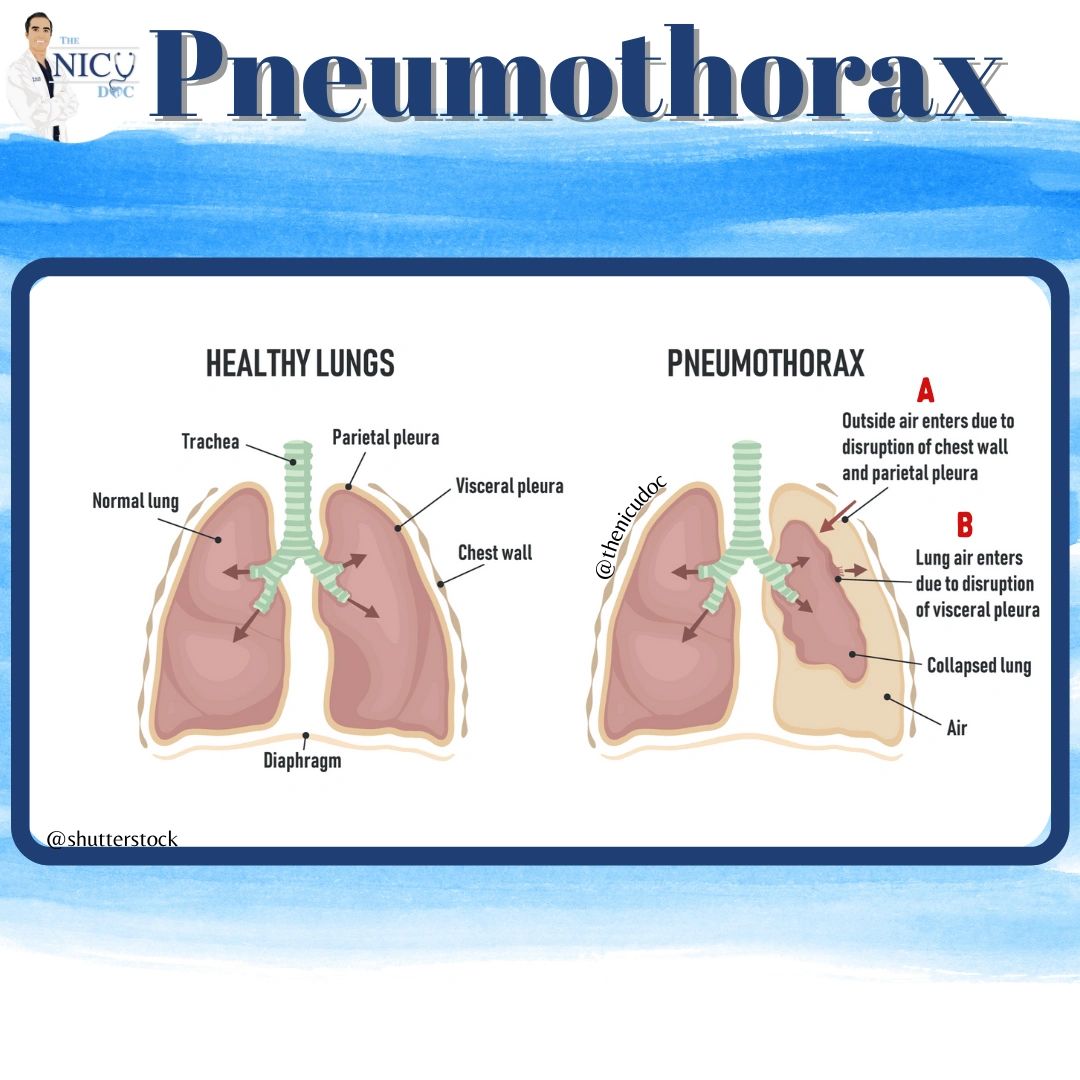 hemopneumothorax diagram