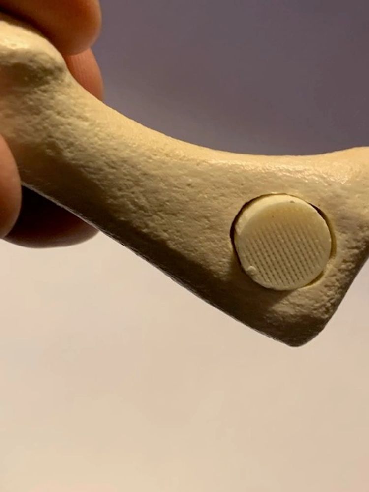 3D printed Metatarsal with printed implant produced with FibreTuff PAPC