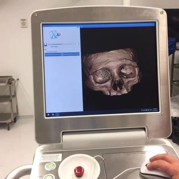 Cranio Maxillofacial 3D printed skull with CT scan