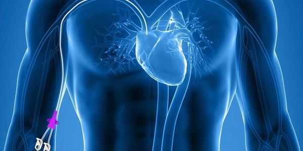 3D medical illustration of a human heart with an intravenous catheter in the arm.