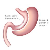 gastric sleeve image