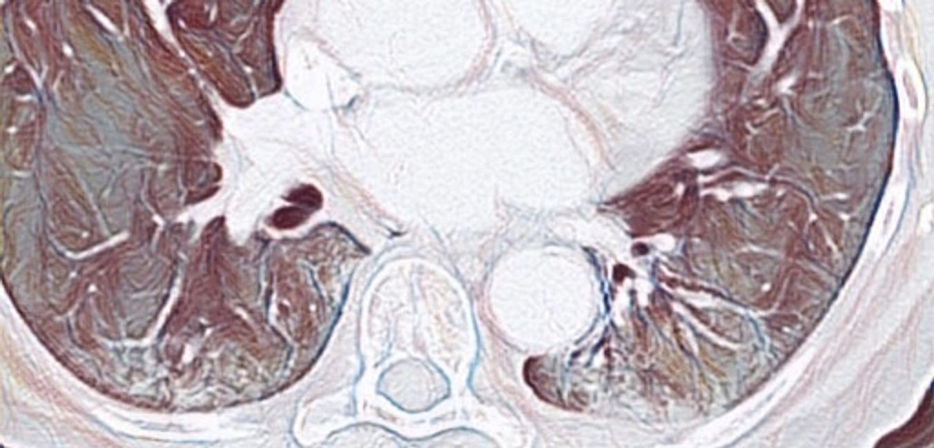 ARSS Anna Reale ODV Fibrosi Polmonare, Sclerosi Sistemica ARSS Anna