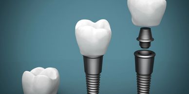 Tooth replacement, shifting and teeth implant services