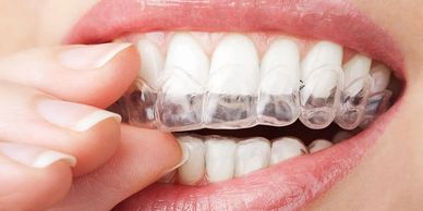 Candid clear aligners and invisalign services in montrose