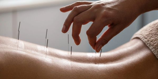 Close-up of acupuncture treatment with needles inserted in a person's back.