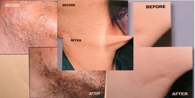skin before and skin after