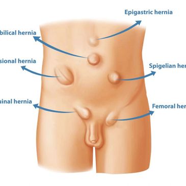 Hernias Causes and Treatments in St.Helier