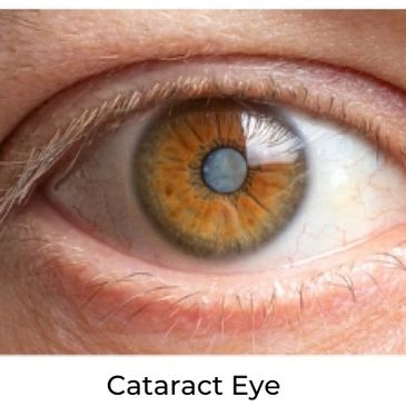 Close-up of an eye with cataract.