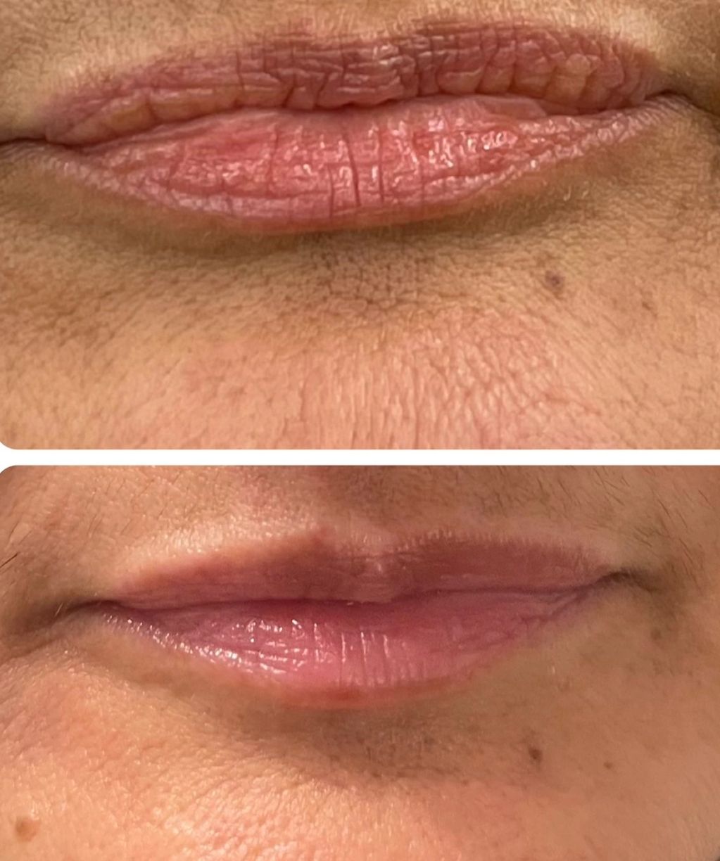 Natural lip enhancement 