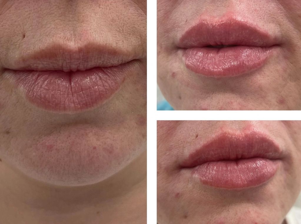 Natural lip enhancement 