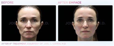 Before and After 4 Sessions of Emface