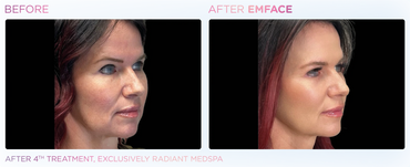 Before and After 4 Sessions of EmFace