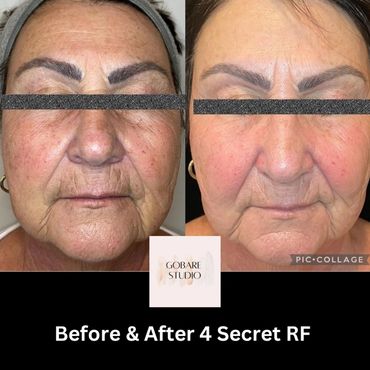 Microneedling with radio frequency secret rf morpheus morpheus 8 anti-aging genesis rosacea