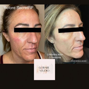 Microneedling Radio Frequency antiaging facial nonsurgical facelift sun damage treatment