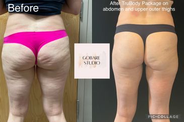 Before and after TruBody treatment showing reduced cellulite on thighs and abdomen.