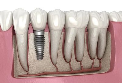 Dental Implants