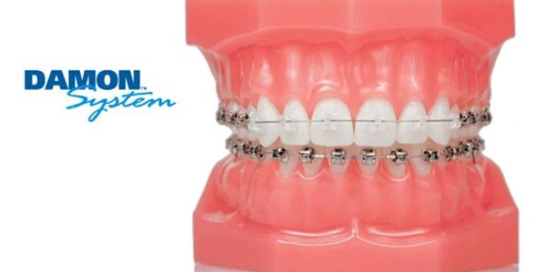 Damon self ligating braces at kapil dental clinic