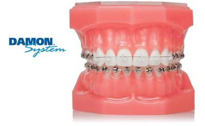 damon orthodontic braces